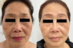 Résultat avant/après traitement anti-âge du visage - amélioration visible des taches pigmentaires et de la texture de la peau