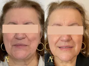 Résultat avant/après traitement anti-âge - exemple client 3