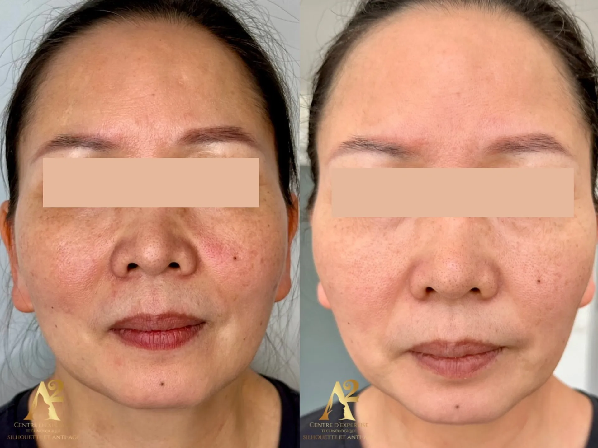 Résultat avant/après traitement anti-âge - exemple client 8